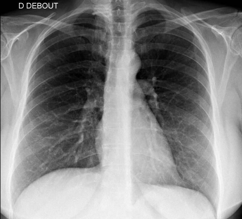 Faire une radiographie du thorax à Marseille et Fuveau